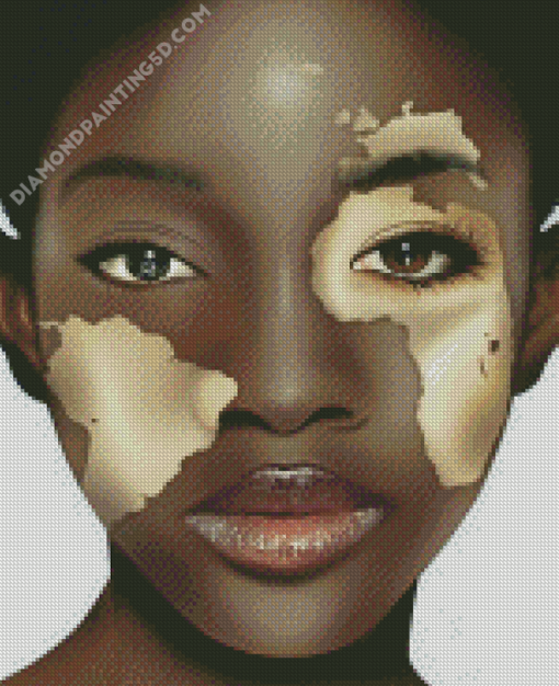 Vitiligo Girl Face Art Diamond Paintings